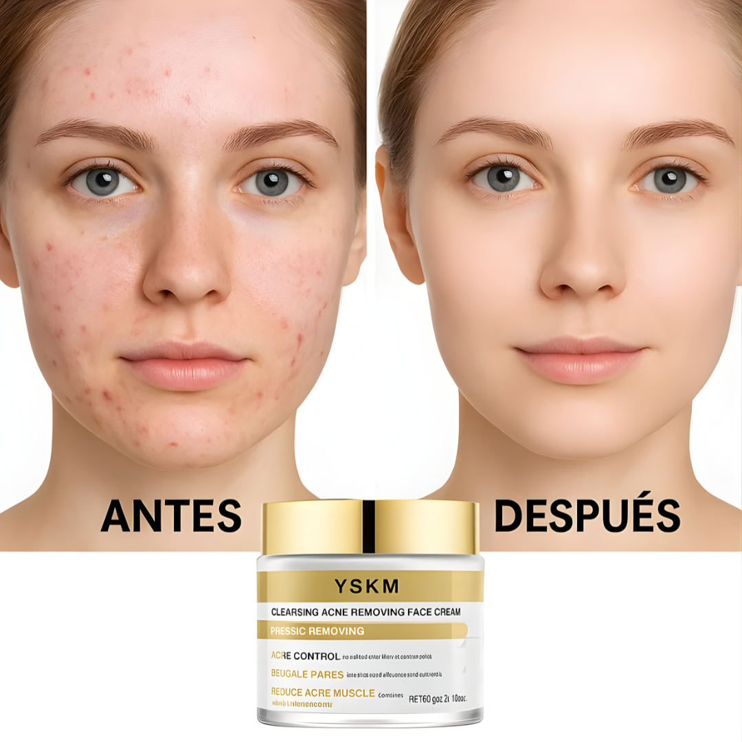 CREMA FACIAL ANTI-ACNE YSKM – Limpieza profunda, control del acné y piel más uniforme día a día