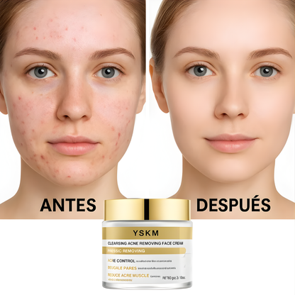 CREMA FACIAL ANTI-ACNE YSKM – Limpieza profunda, control del acné y piel más uniforme día a día
