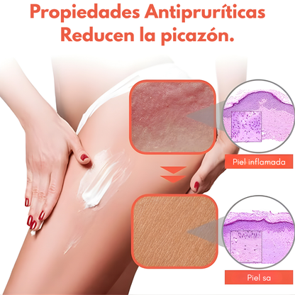 CREMA ANTIPICAZÓN – Alivio instantáneo para tu piel