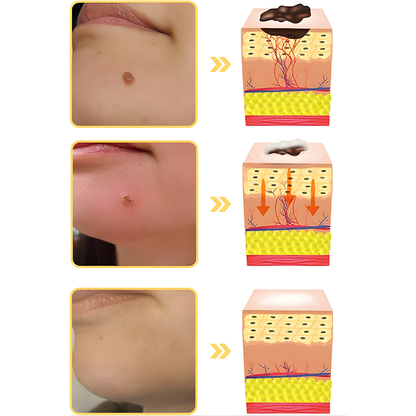 CREMA DE VENENO DE ABEJA PARA REMOVER VERRUGAS, LUNARES, MANCHAS EN LA PIEL – Corrección avanzada, renovación visible y piel más uniforme cada día