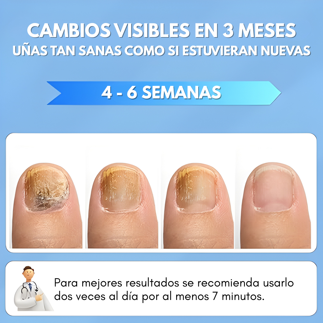 LÁSER PARA HONGOS EN LAS UÑAS – Tratamiento preciso, alivio duradero y tecnología profesional para recuperar uñas saludables