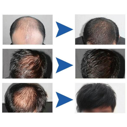 SUERO CAPILAR MONOXIDIL 5% – Reactiva el crecimiento y fortalece el cabello masculino