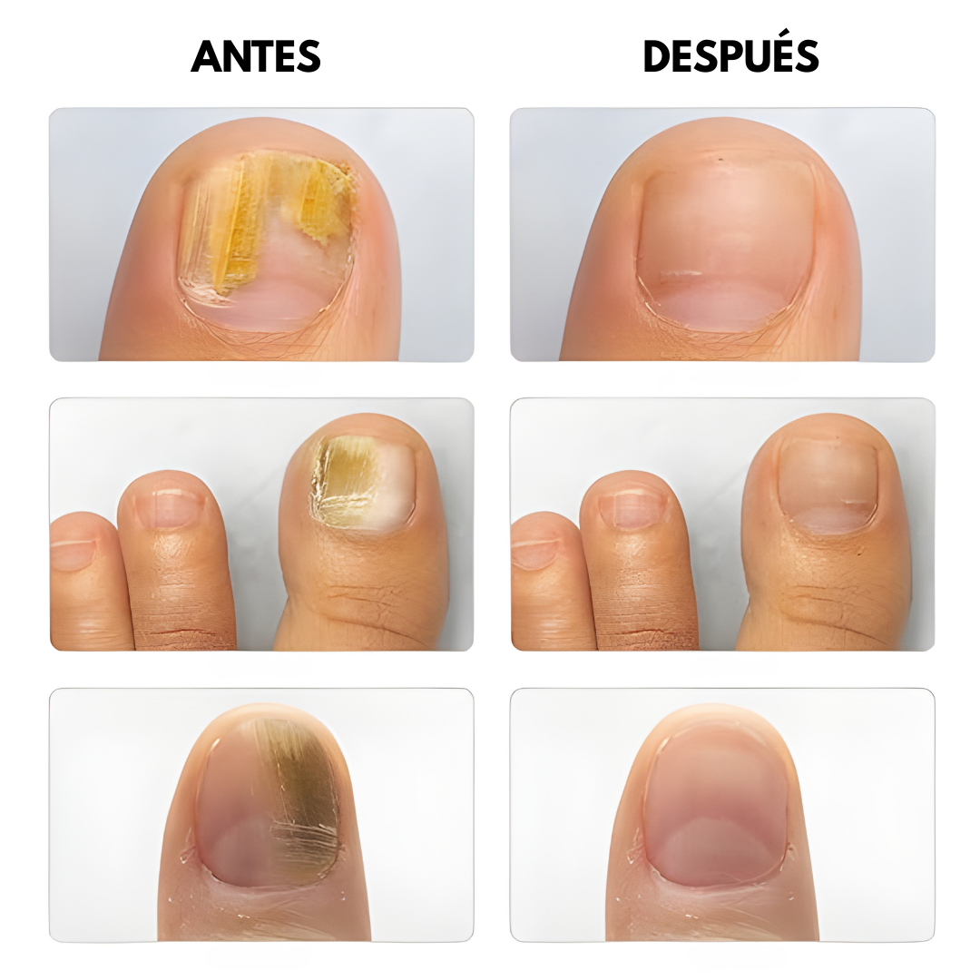 TRATAMIENTO PARA UÑAS CON HONGOS – Cuidado especializado, protección diaria y uñas más saludables