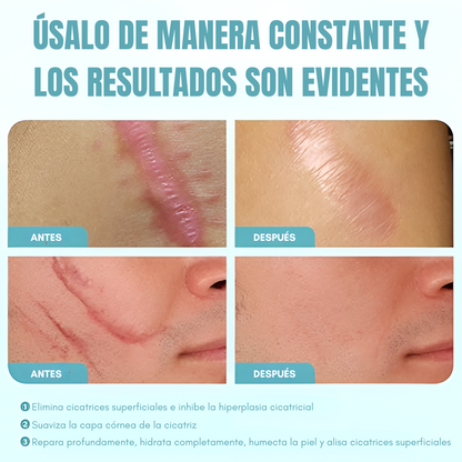 GEL PARA ELIMINAR CICATRICES – Regenera y suaviza tu piel