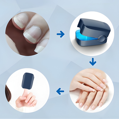 LÁSER PARA HONGOS EN LAS UÑAS – Tratamiento preciso, alivio duradero y tecnología profesional para recuperar uñas saludables