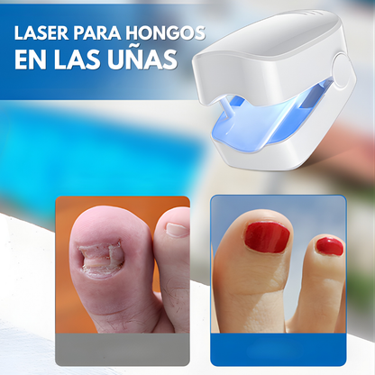 LÁSER PARA HONGOS EN LAS UÑAS – Tratamiento preciso, alivio duradero y tecnología profesional para recuperar uñas saludables